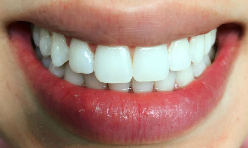Dientes desalineados después de blanquear